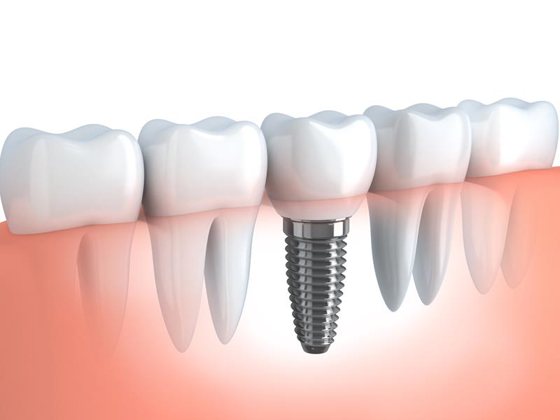 Dental Implants  Brooklyn, NY 